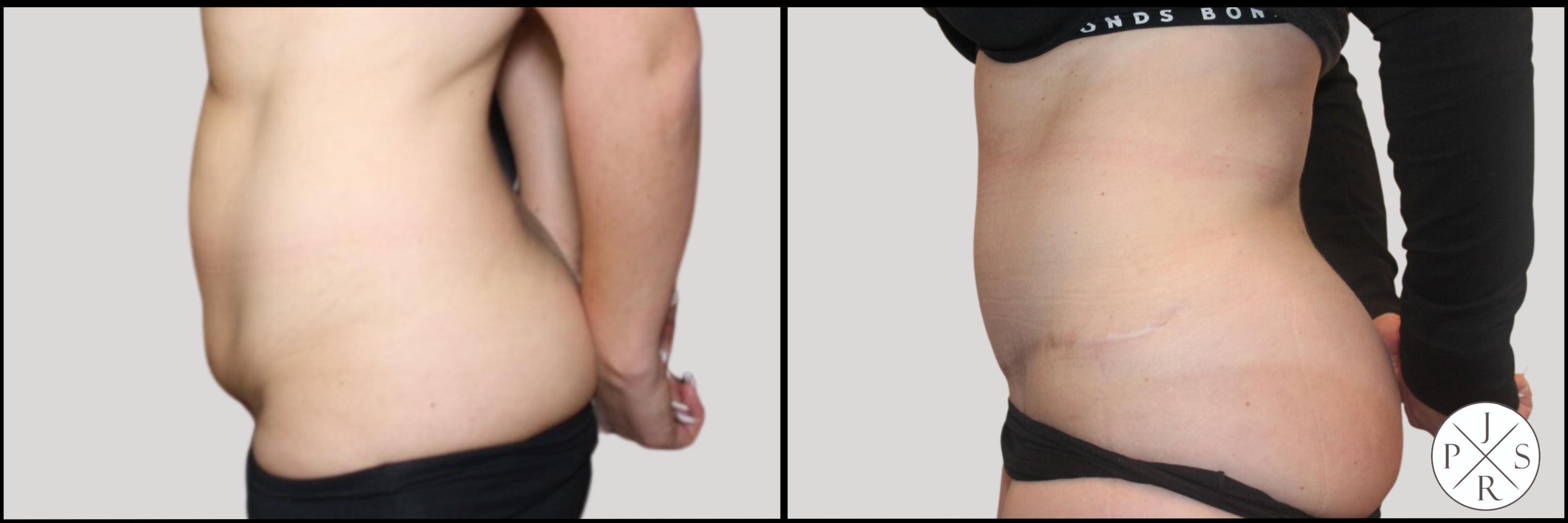 Abdominoplasty Before & After Image